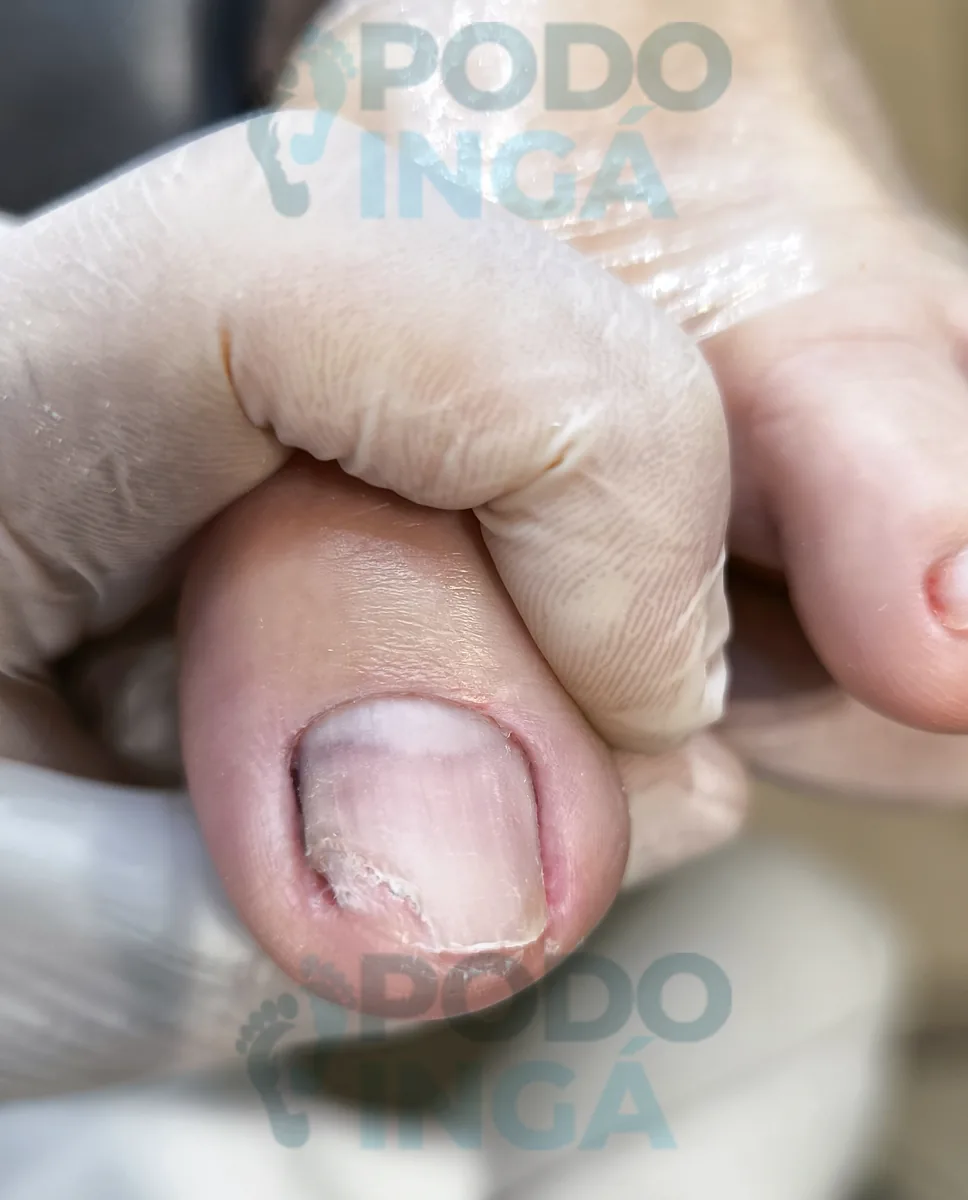 Onicomicose no pé — durante o tratamento — caso 1, tratamento na Podoingá Podologia em Maringá