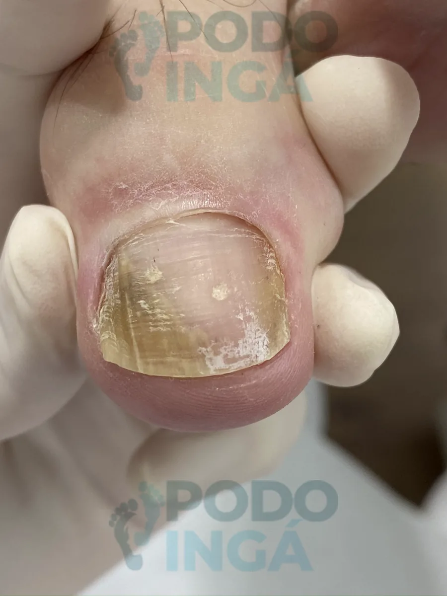 Onicomicose no pé em acompanhamento de tratamento na Podoingá Podologia em Maringá — caso 4, foto 1 de 3