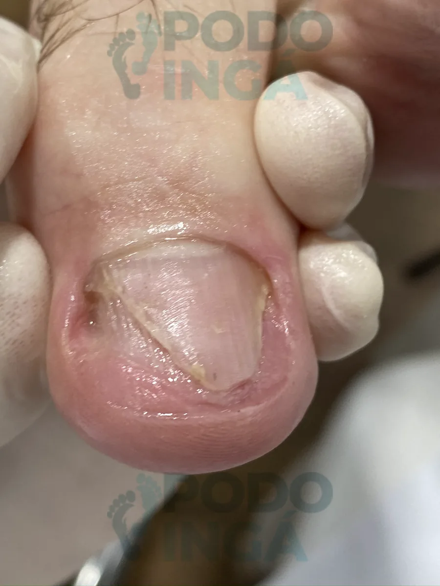 Onicomicose no pé em acompanhamento de tratamento na Podoingá Podologia em Maringá — caso 4, foto 2 de 3