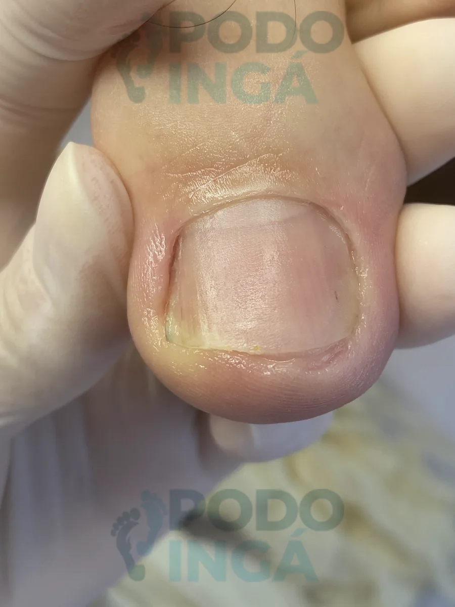 Onicomicose no pé em acompanhamento de tratamento na Podoingá Podologia em Maringá — caso 4, foto 3 de 3