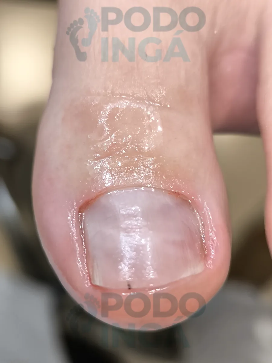 Onicomicose no pé em acompanhamento de tratamento na Podoingá Podologia em Maringá — caso 5, foto 4 de 4