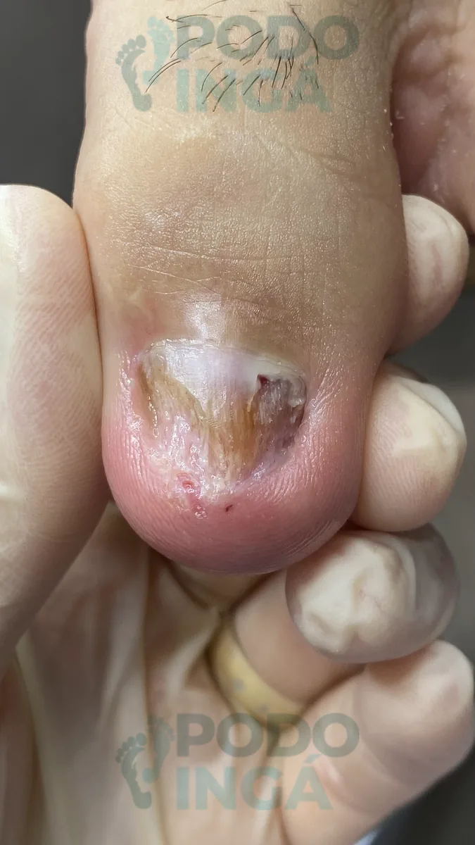 Onicomicose no pé em acompanhamento de tratamento na Podoingá Podologia em Maringá — caso 6, foto 2 de 12