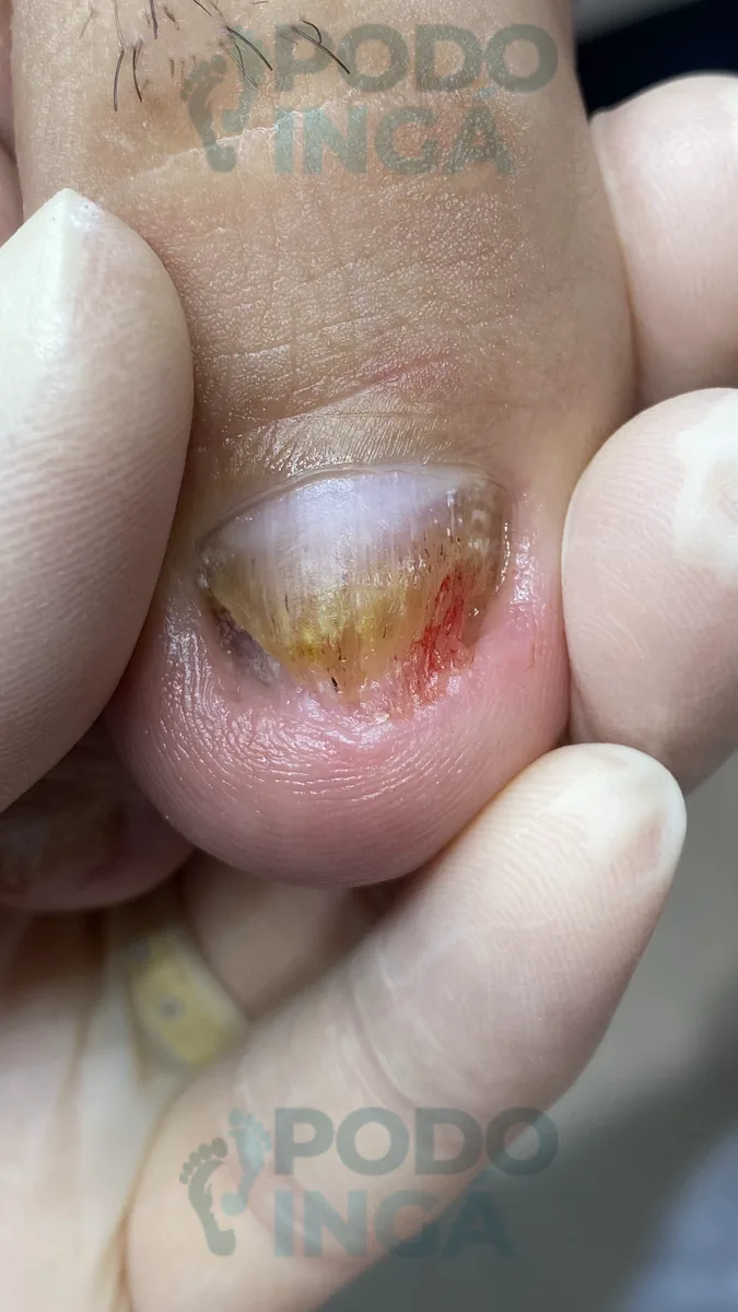 Onicomicose no pé em acompanhamento de tratamento na Podoingá Podologia em Maringá — caso 6, foto 5 de 12
