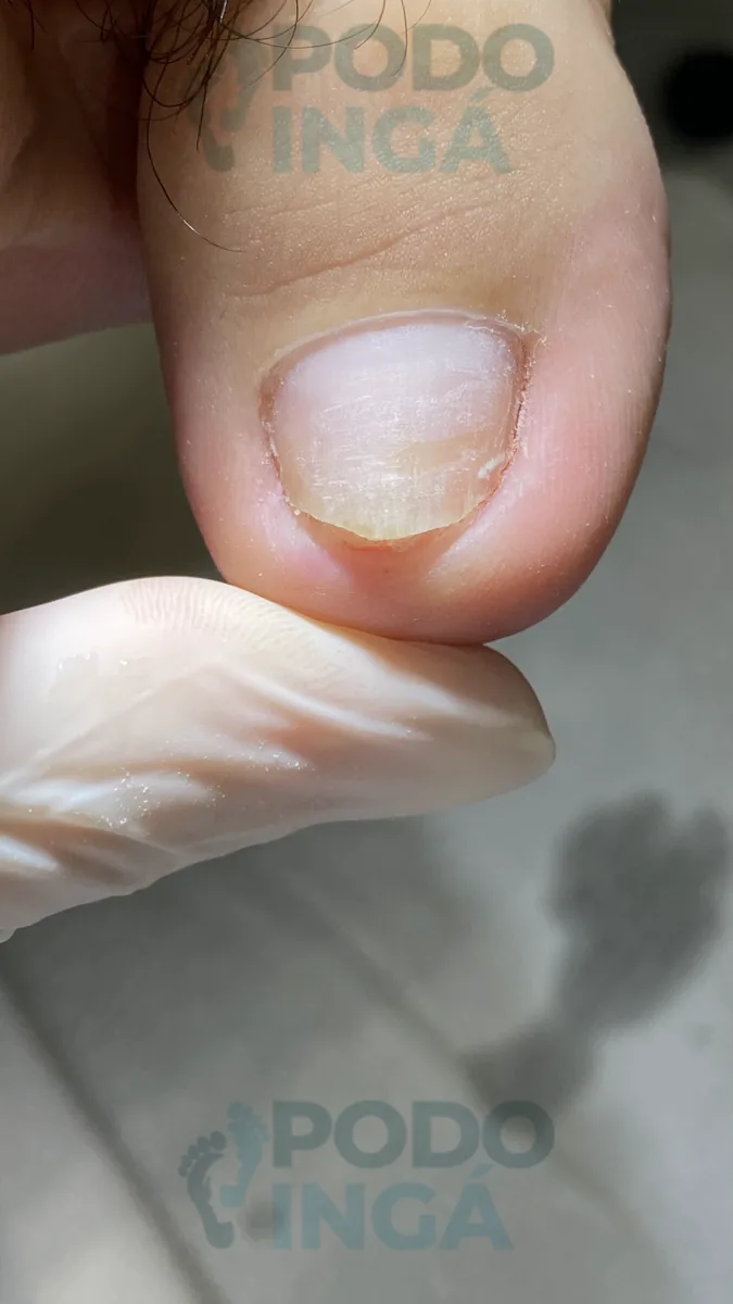 Onicomicose no pé em acompanhamento de tratamento na Podoingá Podologia em Maringá — caso 6, foto 6 de 12