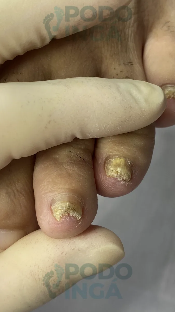 Onicomicose no pé em acompanhamento de tratamento na Podoingá Podologia em Maringá — caso 6, foto 8 de 12
