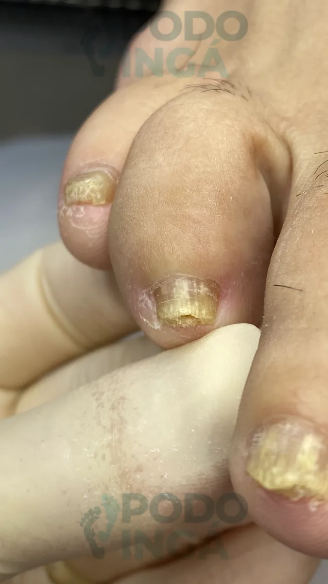 Onicomicose no pé em acompanhamento de tratamento na Podoingá Podologia em Maringá — caso 6, foto 10 de 12