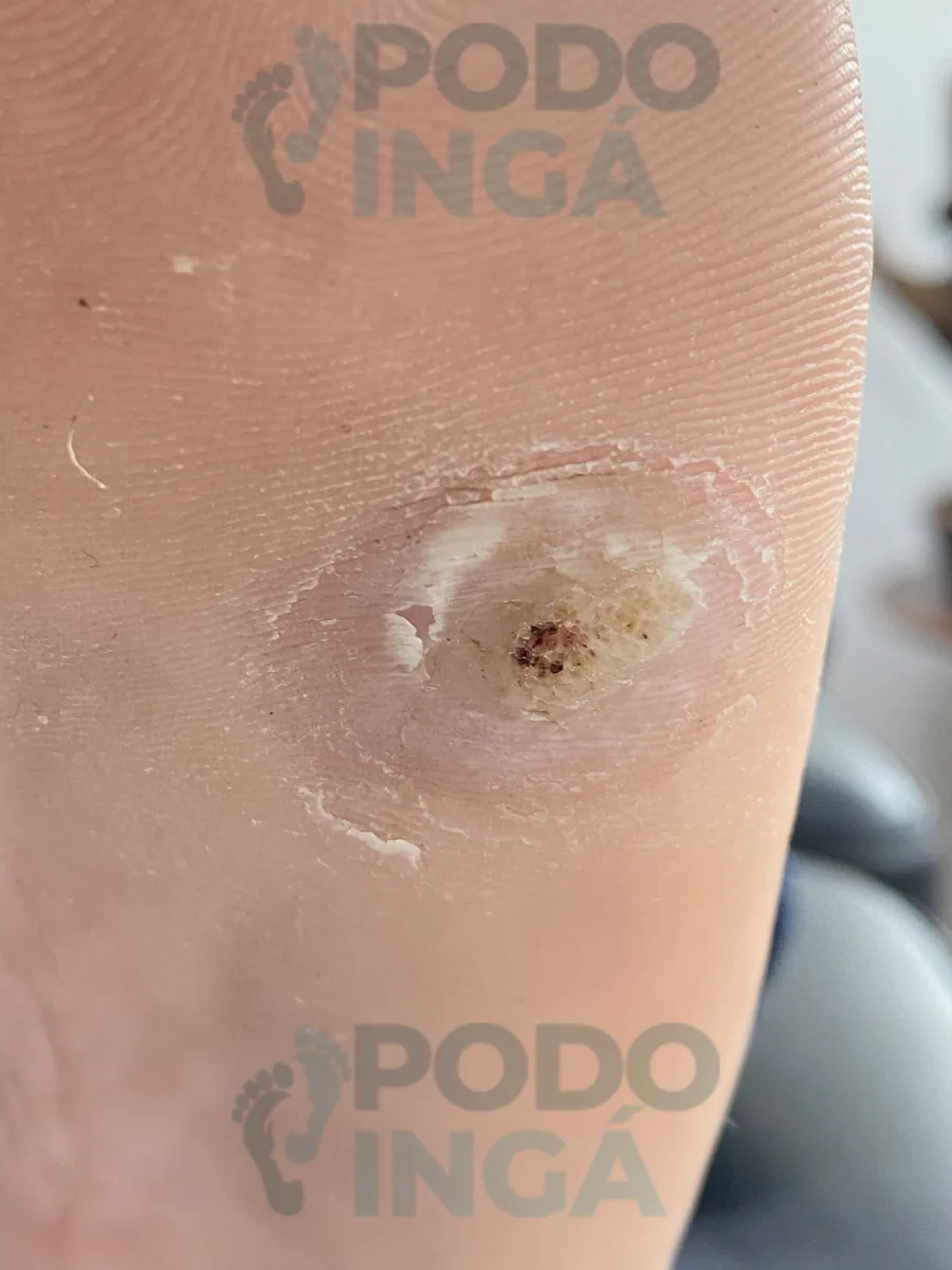 Detalhe da verruga plantar antes do tratamento, com a lesão central visível
