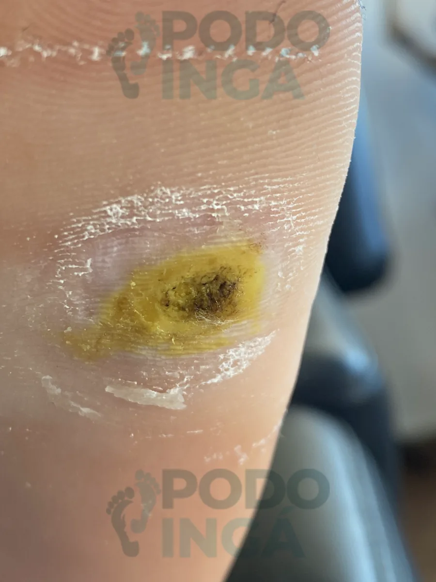 Verruga plantar após o desbaste, com o ativo aplicado sobre a lesão