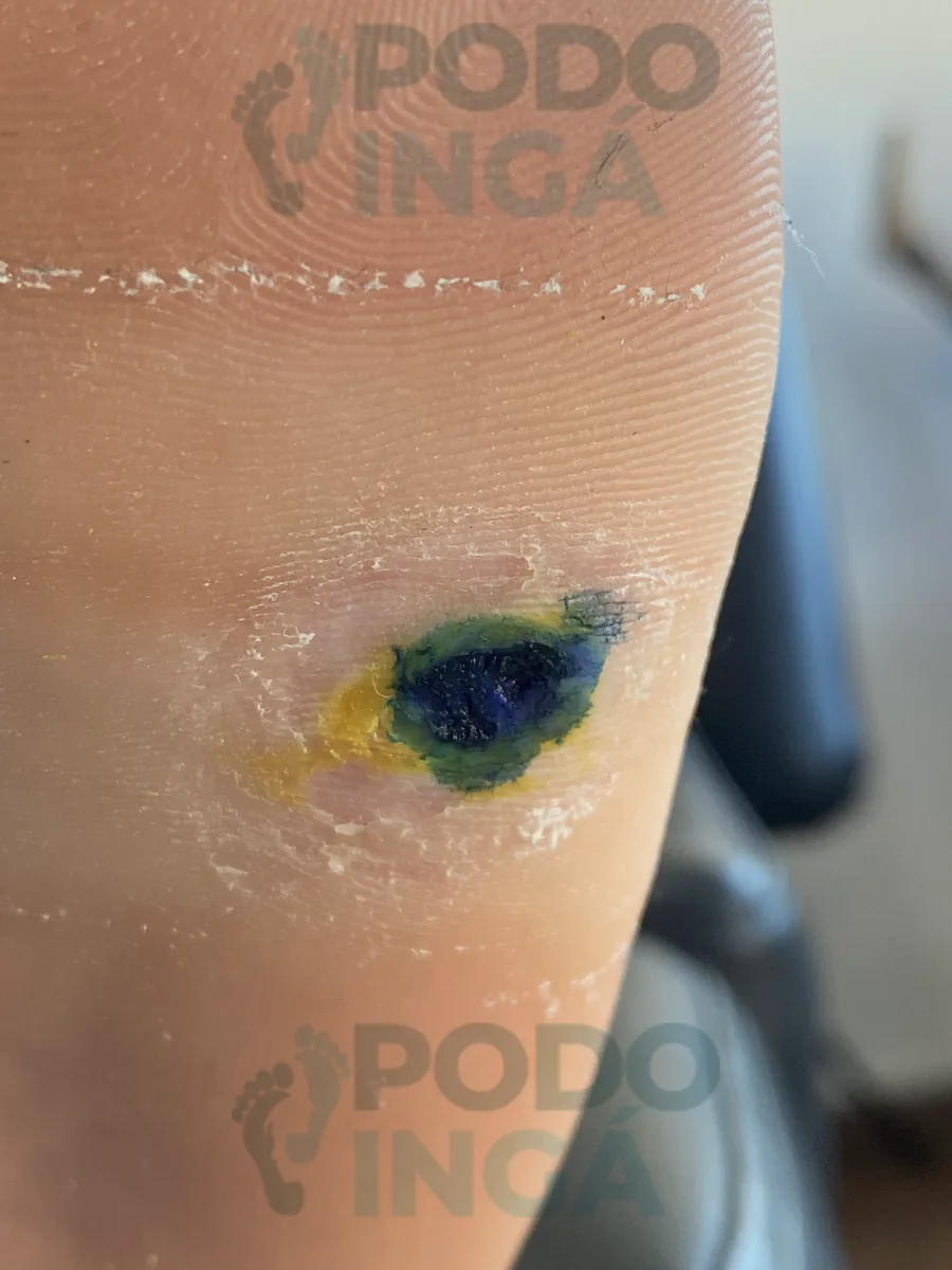 Verruga plantar em sessão de tratamento, com o produto aplicado sobre a lesão