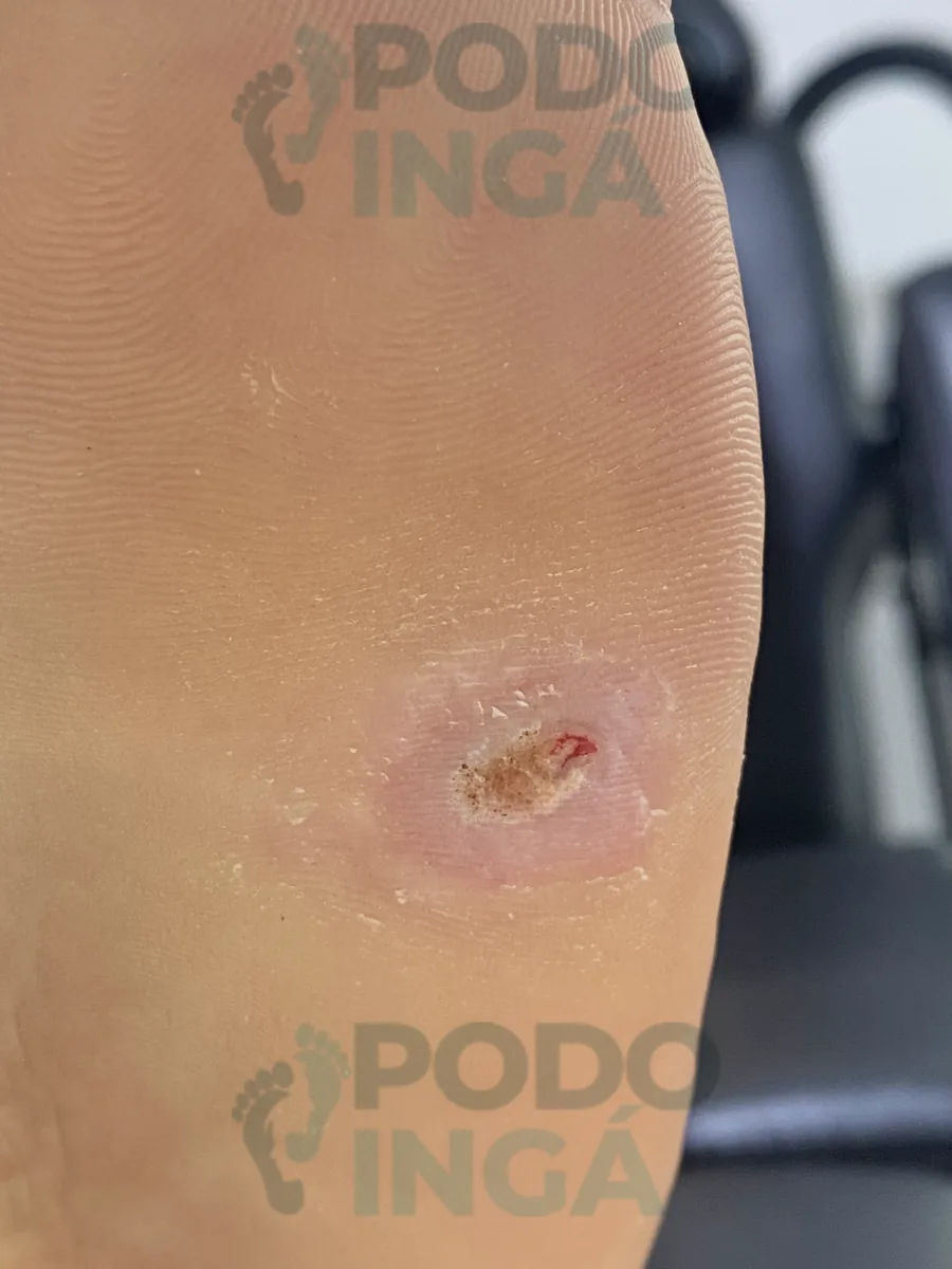 Verruga plantar em evolução, com a lesão visivelmente menor