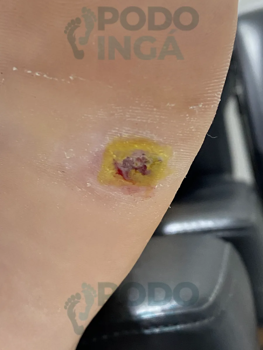 Verruga plantar em nova sessão de tratamento na Podoingá Podologia em Maringá