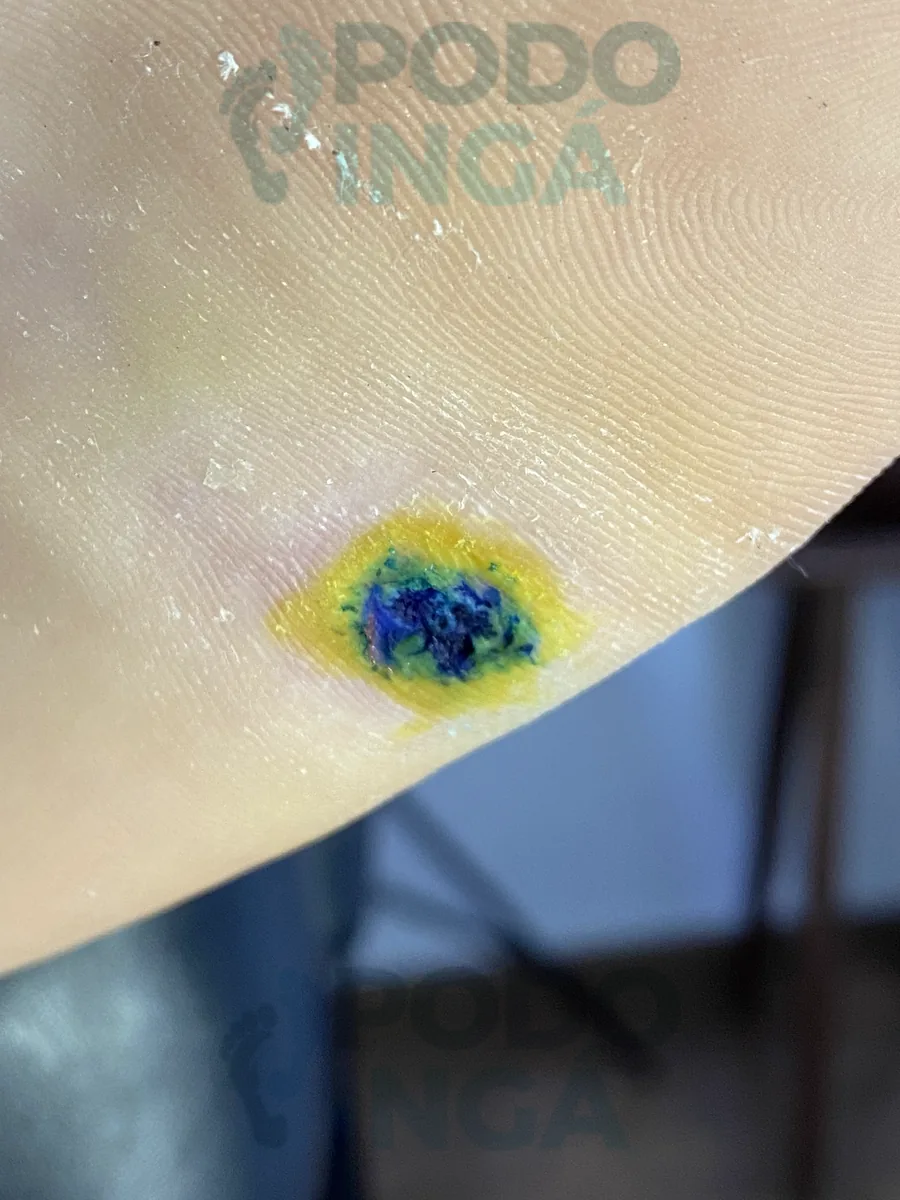 Verruga plantar na última fase do tratamento, com o produto aplicado