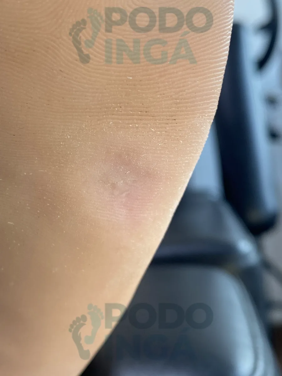 Pele do pé cicatrizada após o tratamento completo da verruga plantar na Podoingá Podologia em Maringá