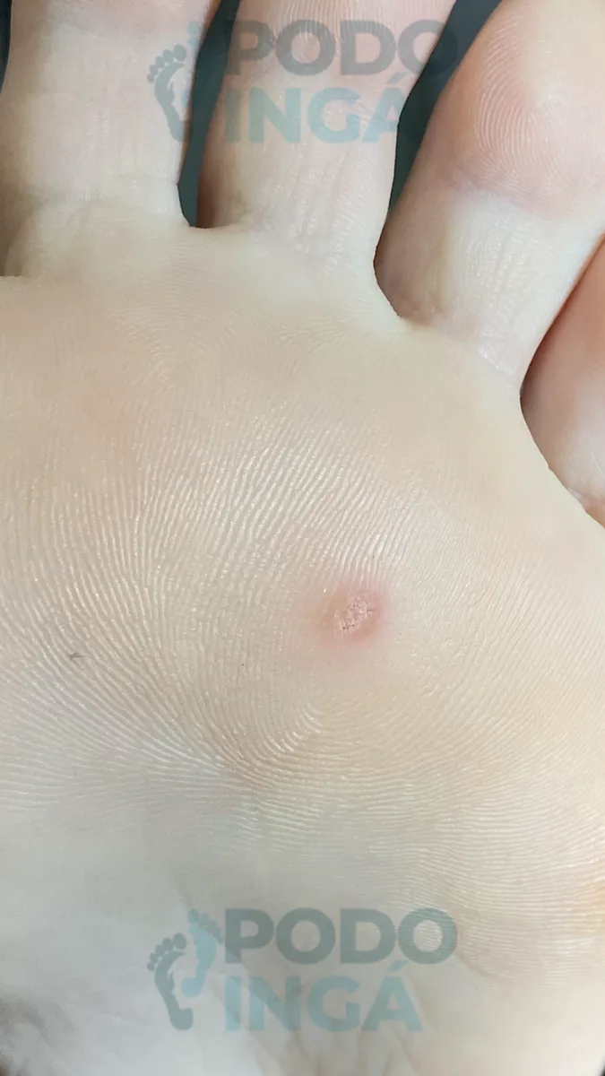 Verruga plantar em acompanhamento de tratamento na Podoingá Podologia em Maringá — caso 2, foto 1 de 3