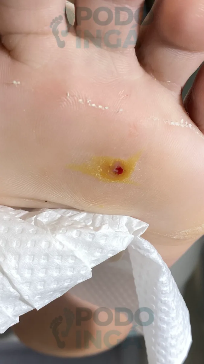 Verruga plantar em acompanhamento de tratamento na Podoingá Podologia em Maringá — caso 2, foto 2 de 3