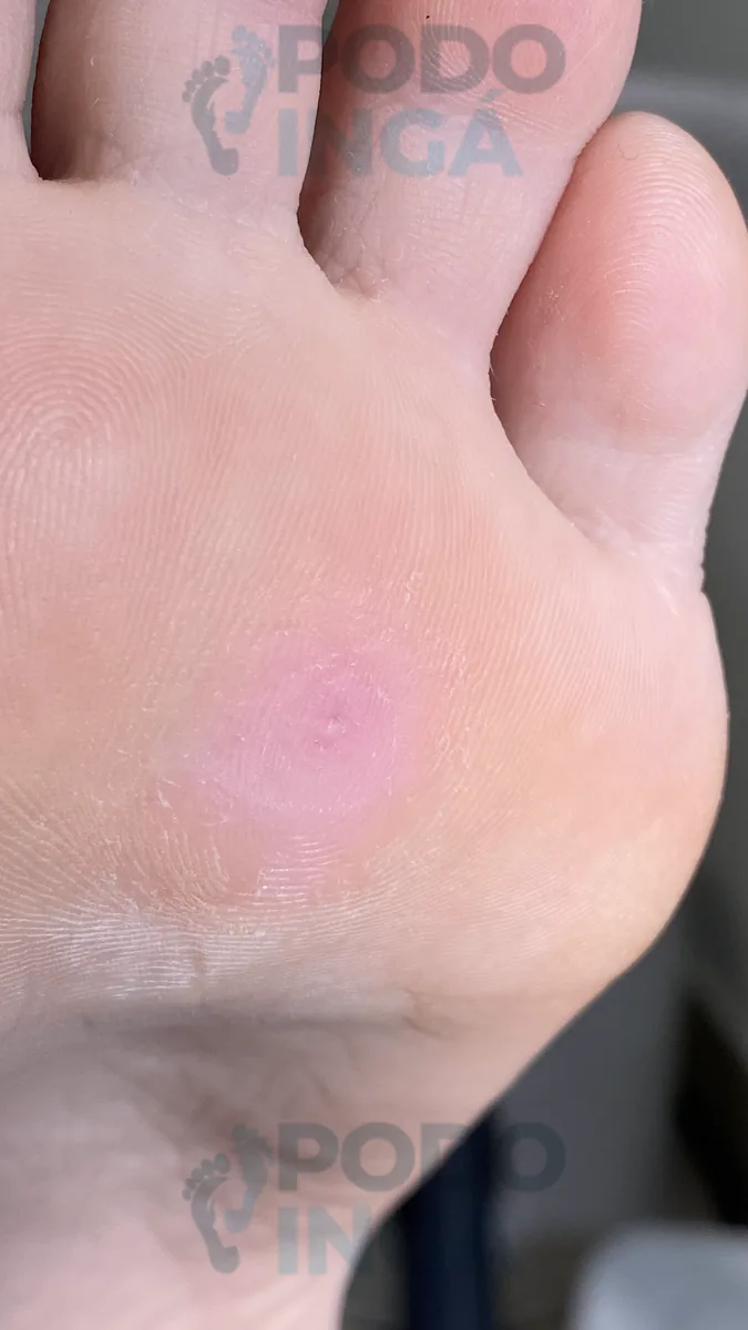 Verruga plantar em acompanhamento de tratamento na Podoingá Podologia em Maringá — caso 2, foto 3 de 3