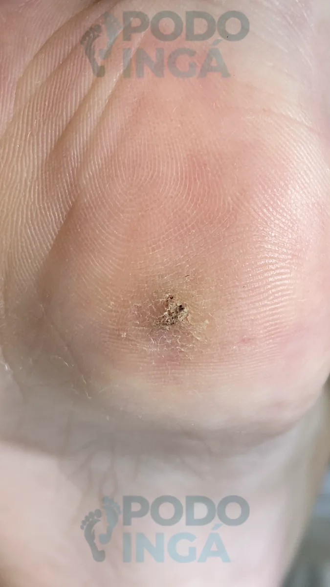 Verruga plantar em acompanhamento de tratamento na Podoingá Podologia em Maringá — caso 3, foto 1 de 6