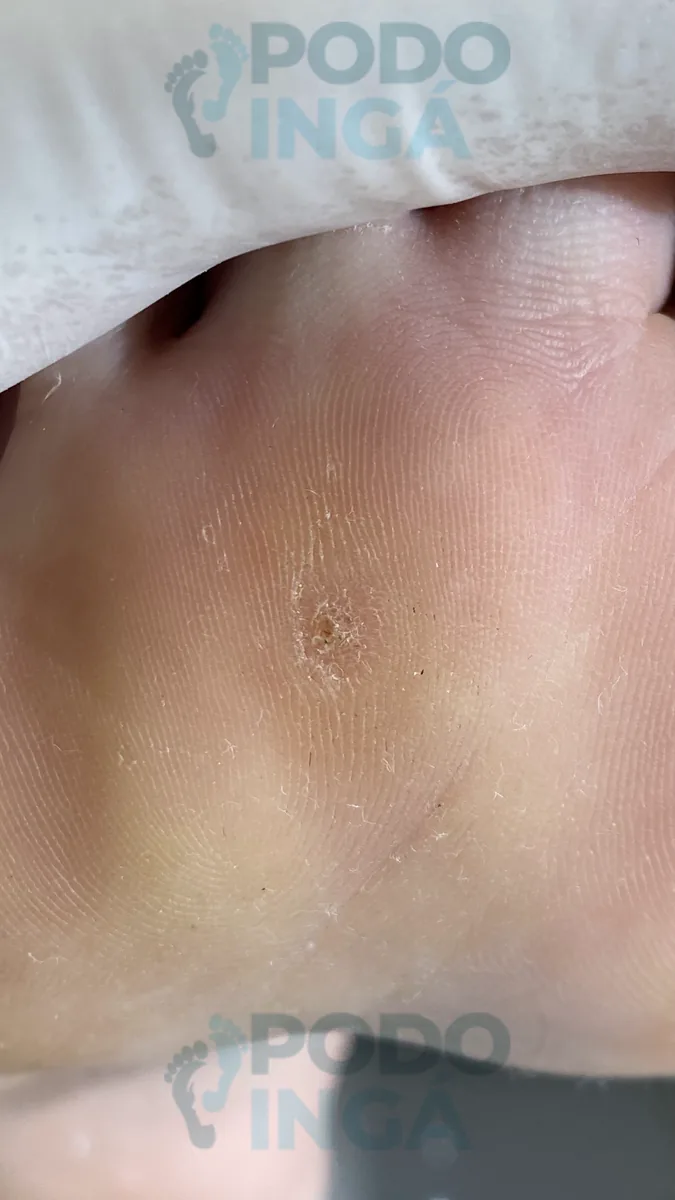 Verruga plantar em acompanhamento de tratamento na Podoingá Podologia em Maringá — caso 3, foto 2 de 6