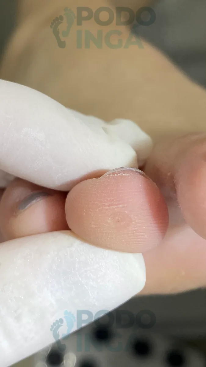 Verruga plantar em acompanhamento de tratamento na Podoingá Podologia em Maringá — caso 3, foto 3 de 6