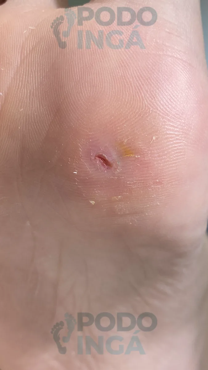 Verruga plantar em acompanhamento de tratamento na Podoingá Podologia em Maringá — caso 3, foto 4 de 6