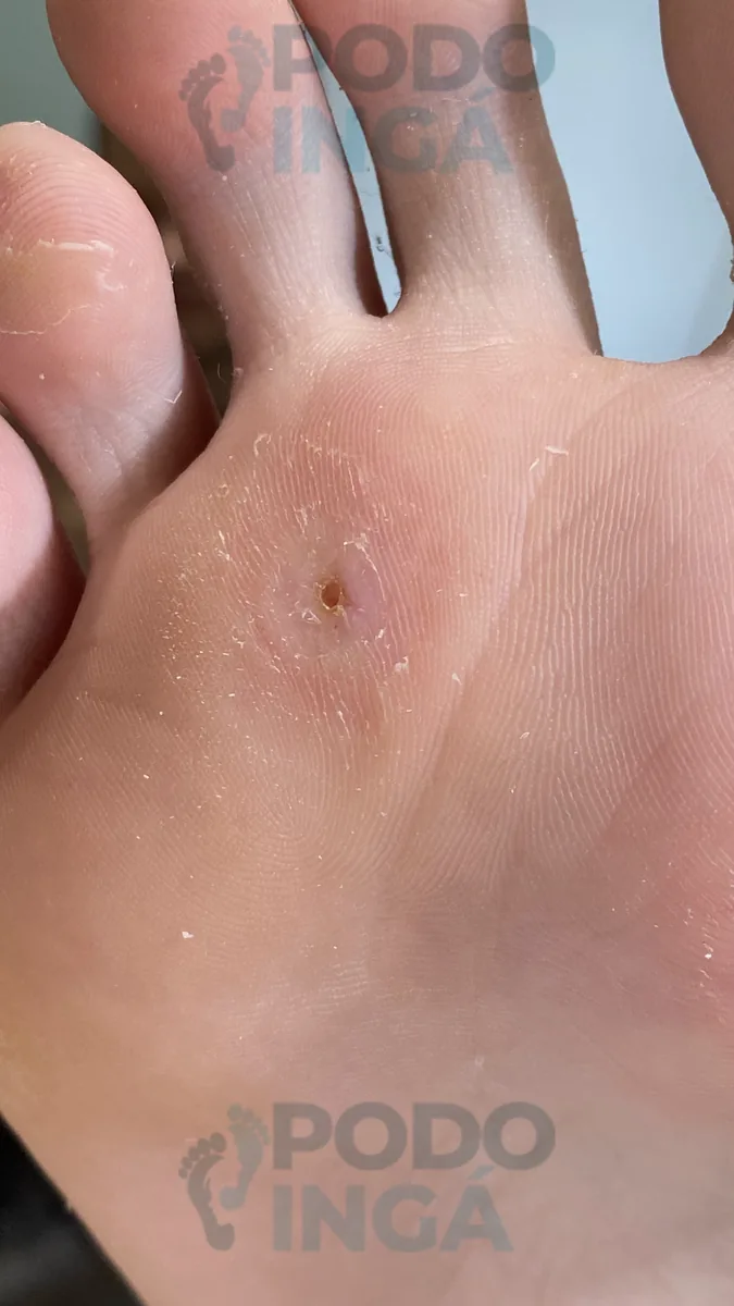Verruga plantar em acompanhamento de tratamento na Podoingá Podologia em Maringá — caso 3, foto 5 de 6