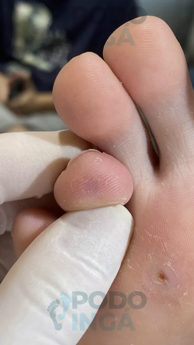 Verruga plantar em acompanhamento de tratamento na Podoingá Podologia em Maringá — caso 3, foto 6 de 6