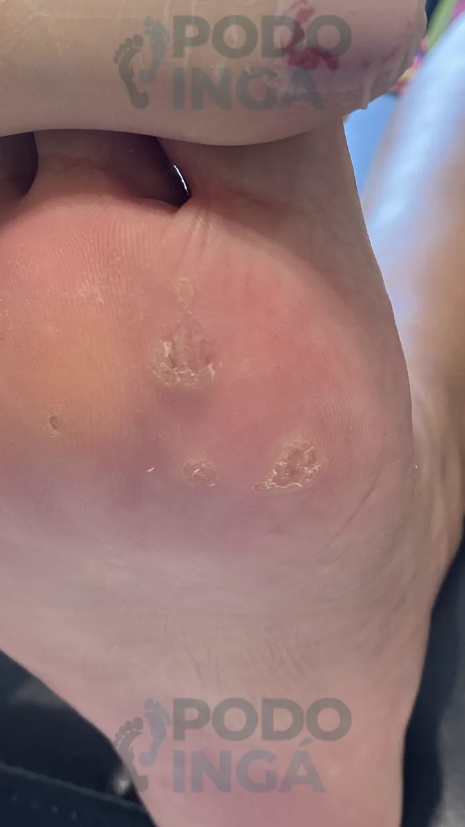Verruga plantar em acompanhamento de tratamento na Podoingá Podologia em Maringá — caso 4, foto 1 de 8