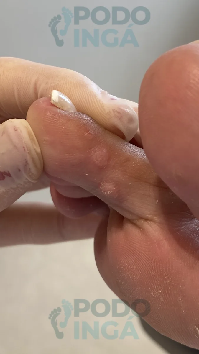 Verruga plantar em acompanhamento de tratamento na Podoingá Podologia em Maringá — caso 4, foto 2 de 8