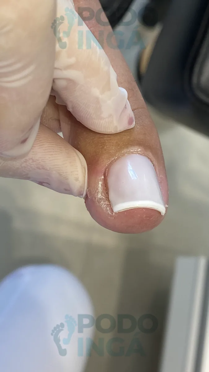 Verruga plantar em acompanhamento de tratamento na Podoingá Podologia em Maringá — caso 4, foto 3 de 8