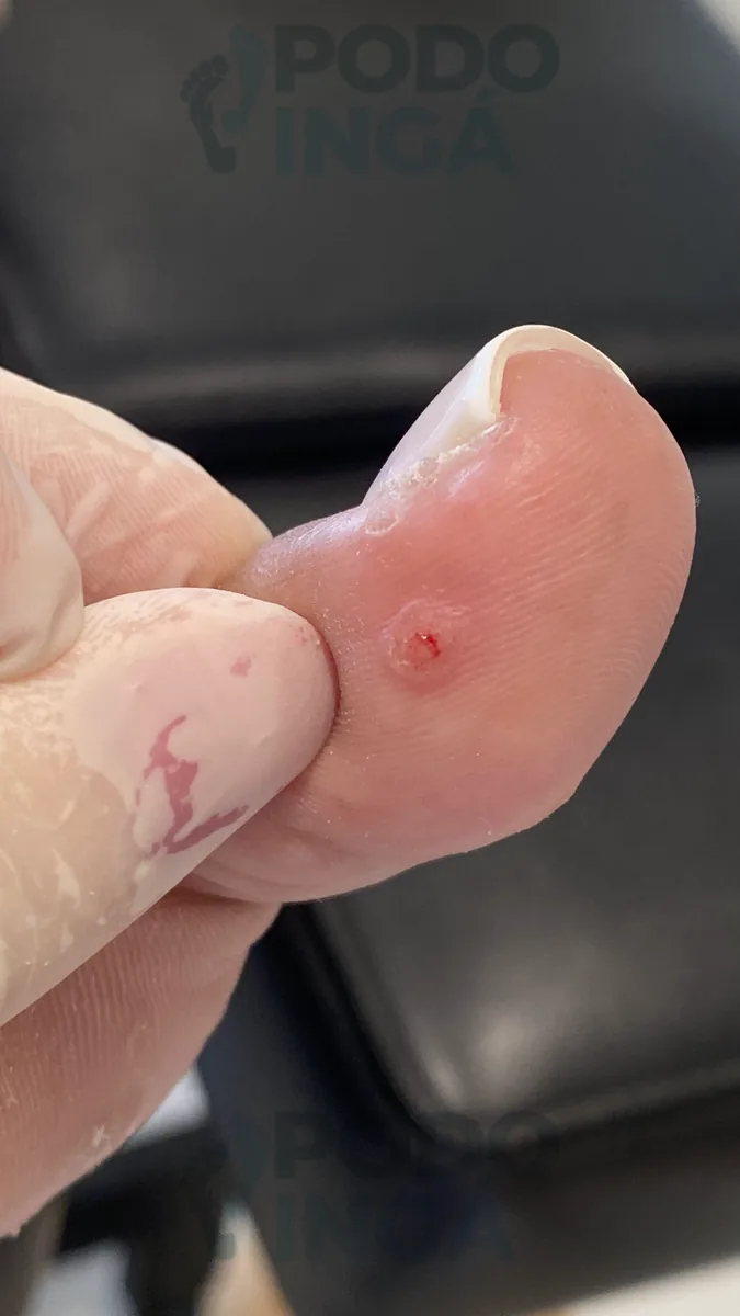 Verruga plantar em acompanhamento de tratamento na Podoingá Podologia em Maringá — caso 4, foto 4 de 8