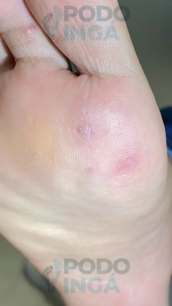Verruga plantar em acompanhamento de tratamento na Podoingá Podologia em Maringá — caso 4, foto 5 de 8