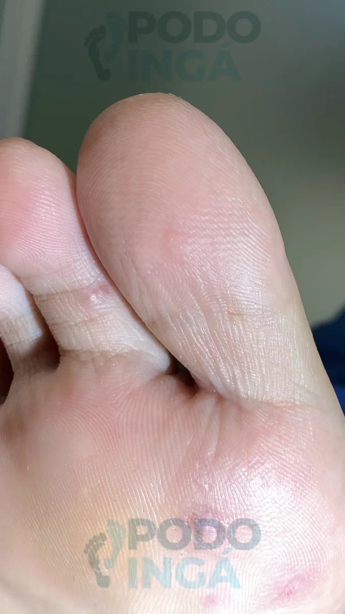 Verruga plantar em acompanhamento de tratamento na Podoingá Podologia em Maringá — caso 4, foto 6 de 8