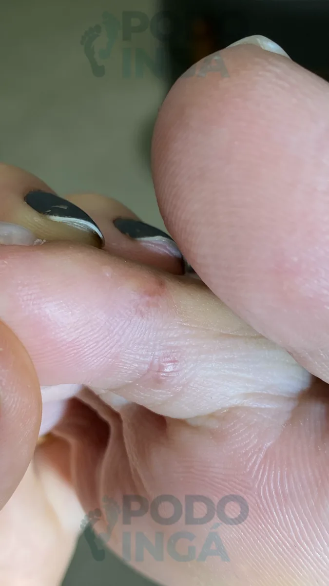 Verruga plantar em acompanhamento de tratamento na Podoingá Podologia em Maringá — caso 4, foto 7 de 8